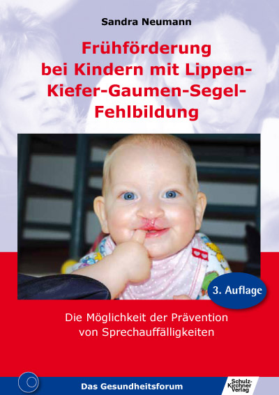 LKGS Lippen-Kiefer-Gaumen-Segel-Fehlbildung